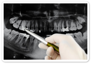 Dental X-rays (Panorama - Röntgenaufnahme)